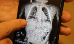 200 binde bir rastlanan hastalık Diyarbakır’da başarıyla tedavi edildi