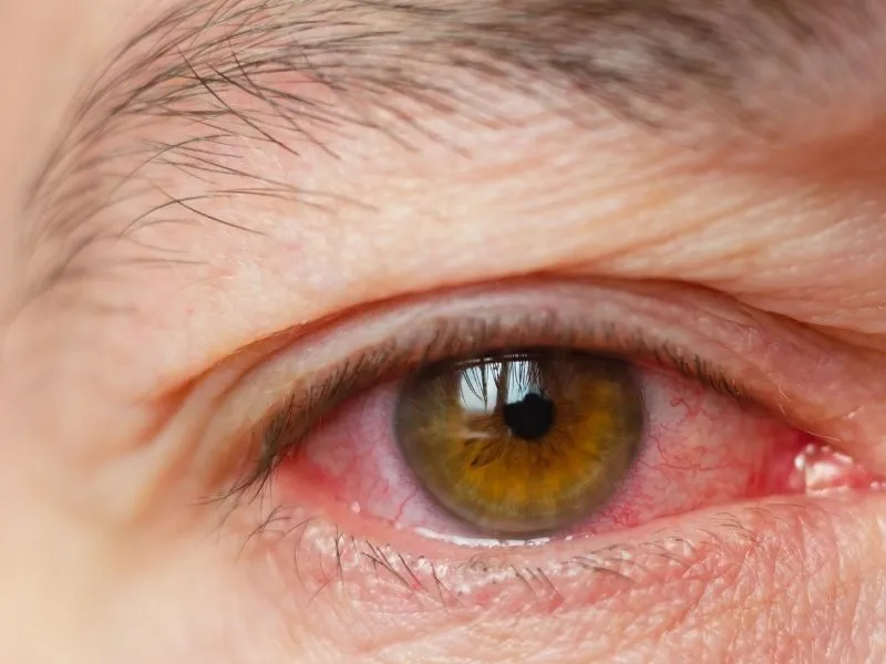 Diyarbakır’da Kış Mevsimi Göz Enfeksiyonlarını Artırıyor2