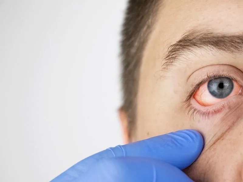 Diyarbakır’da Kış Mevsimi Göz Enfeksiyonlarını Artırıyor3